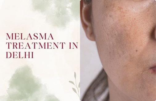 Melasma Treatment in Delhi