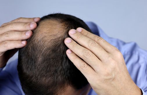 hair loss treatment for men in Delhi