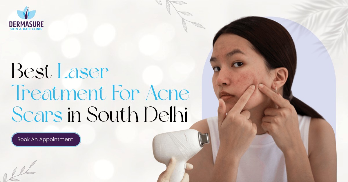 Laser Treatment For Acne Scars in Delhi