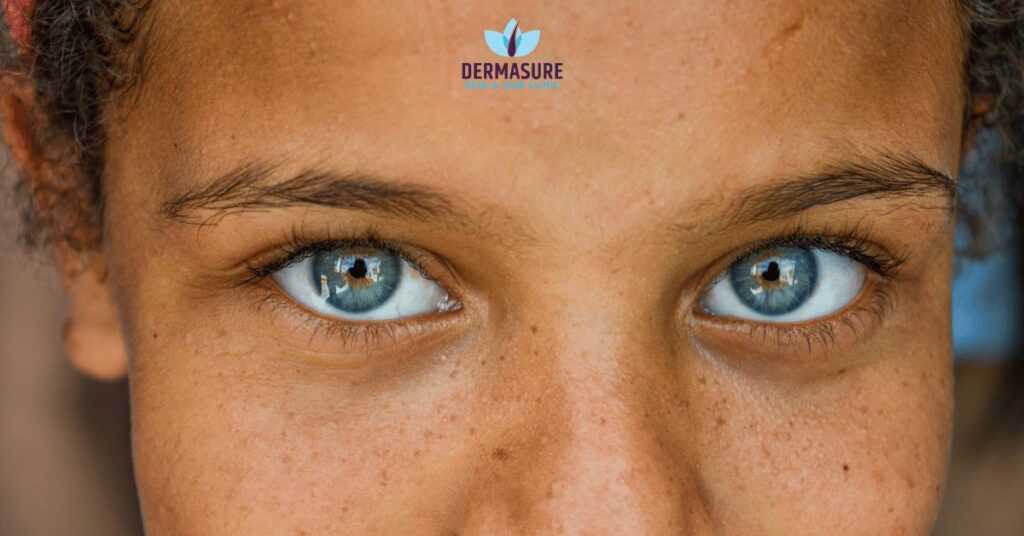 Dark Spot Treatment in Delhi