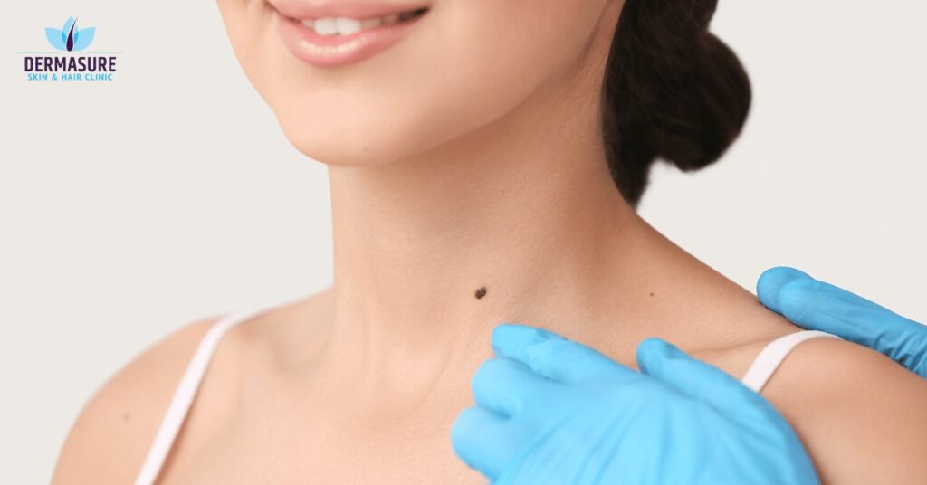 Mole Removal Dermatologist in South Delhi