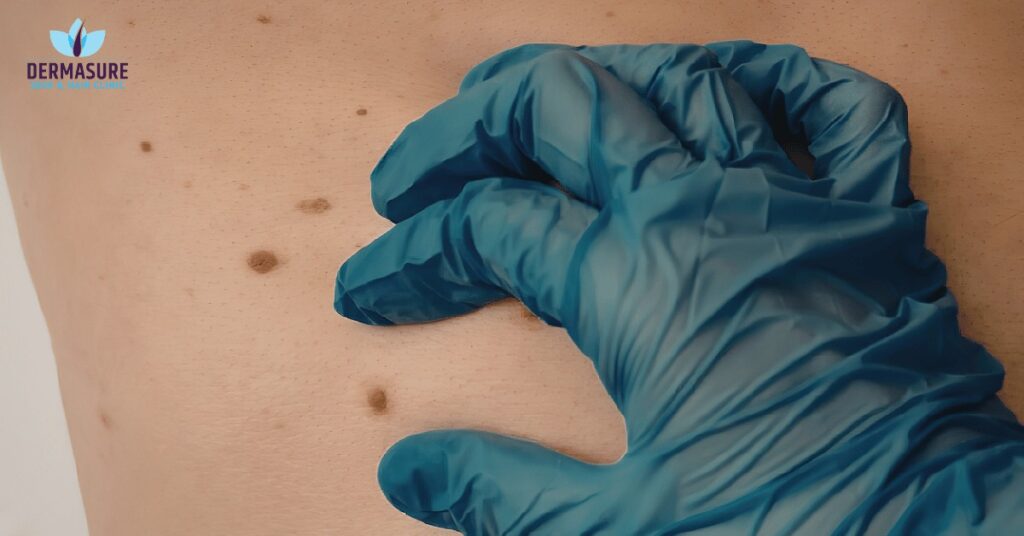 Mole Removal Dermatologist in South Delhi