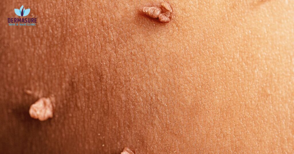 Wart & Mole Removal Treatments in South Delhi