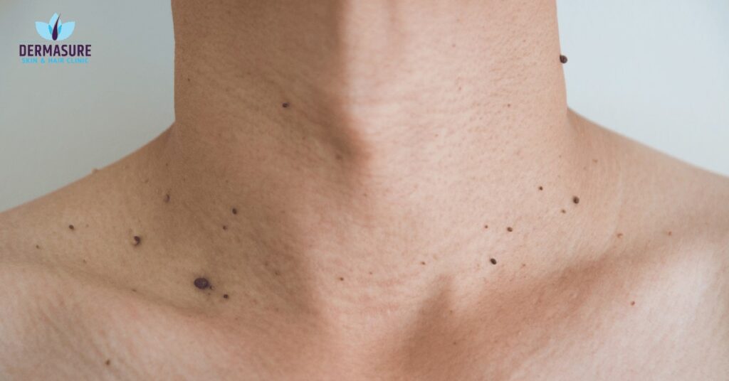 Wart & Mole Removal Treatments in South Delhi