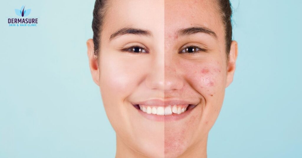 Before and after acne scar removal results at Dermasure Delhi